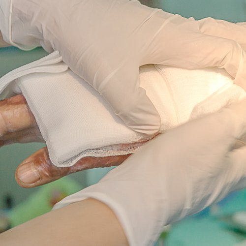 cirurgia de reparação de ciatriz de queimadura